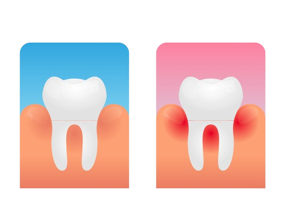 Advanced Gum Treatments